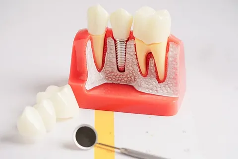 Dental Implants vs Dentures