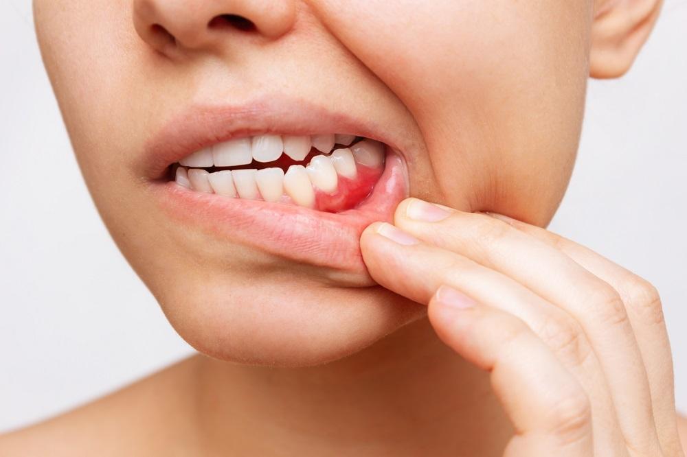 gum swelling treatment in horamavu