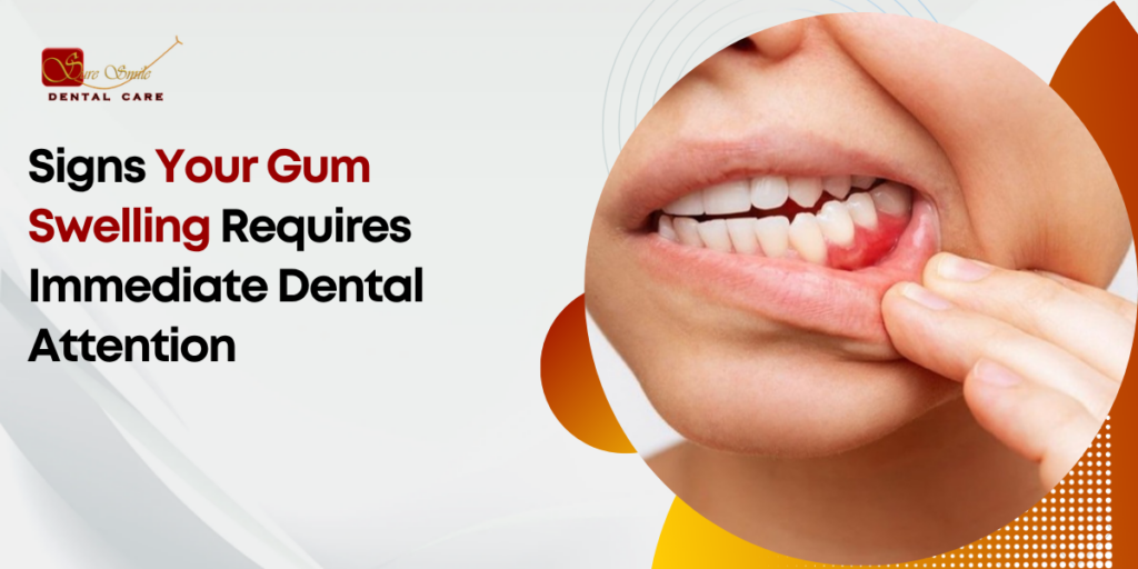 gum swelling treatment in horamavu