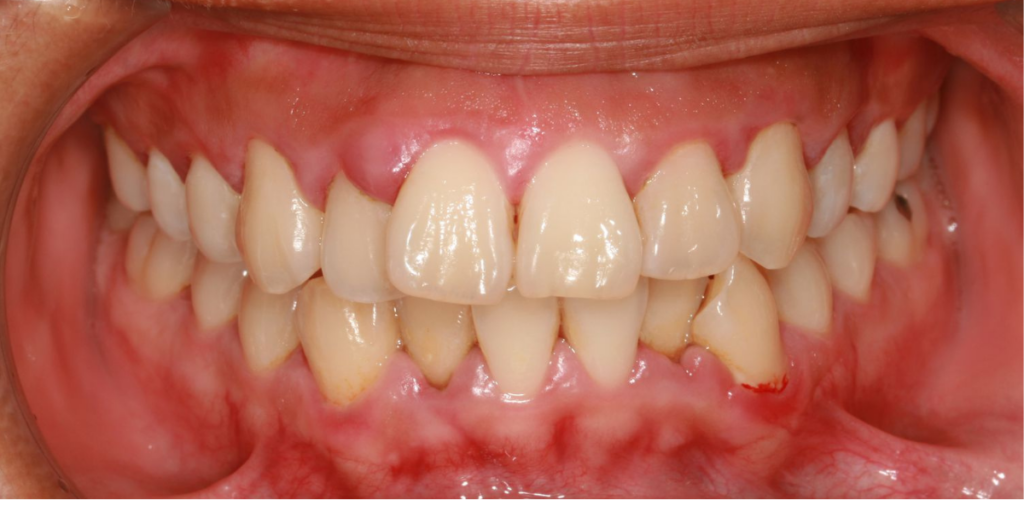 gum swelling