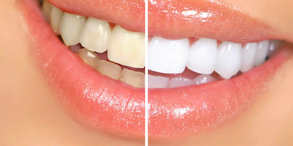teeth white