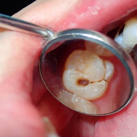 Cavity Treatment Bangalore