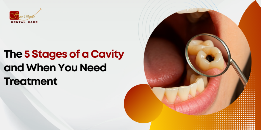 The 5 Stages of a Cavity and When You Need Treatment