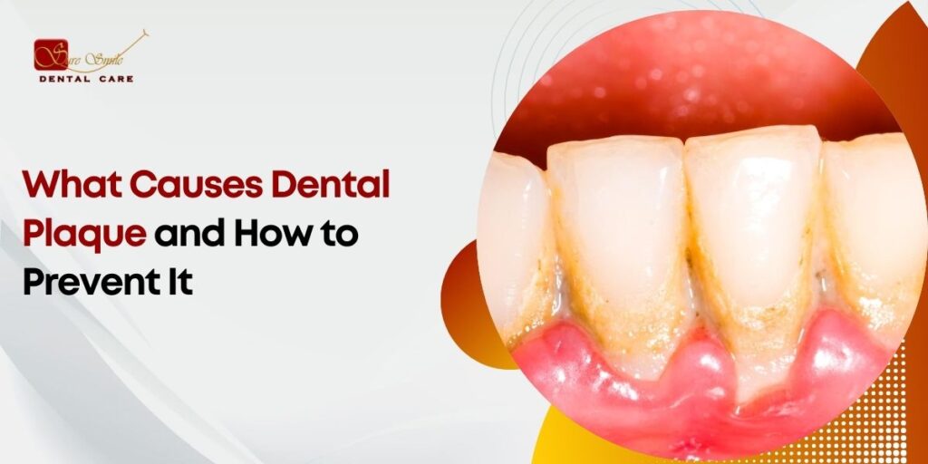 What Causes Dental Plaque and How to Prevent It