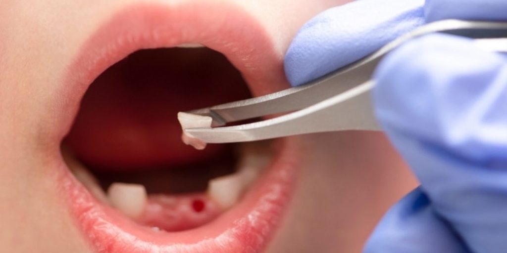 How to Relieve Pain After Tooth Extraction When It Gets Worse