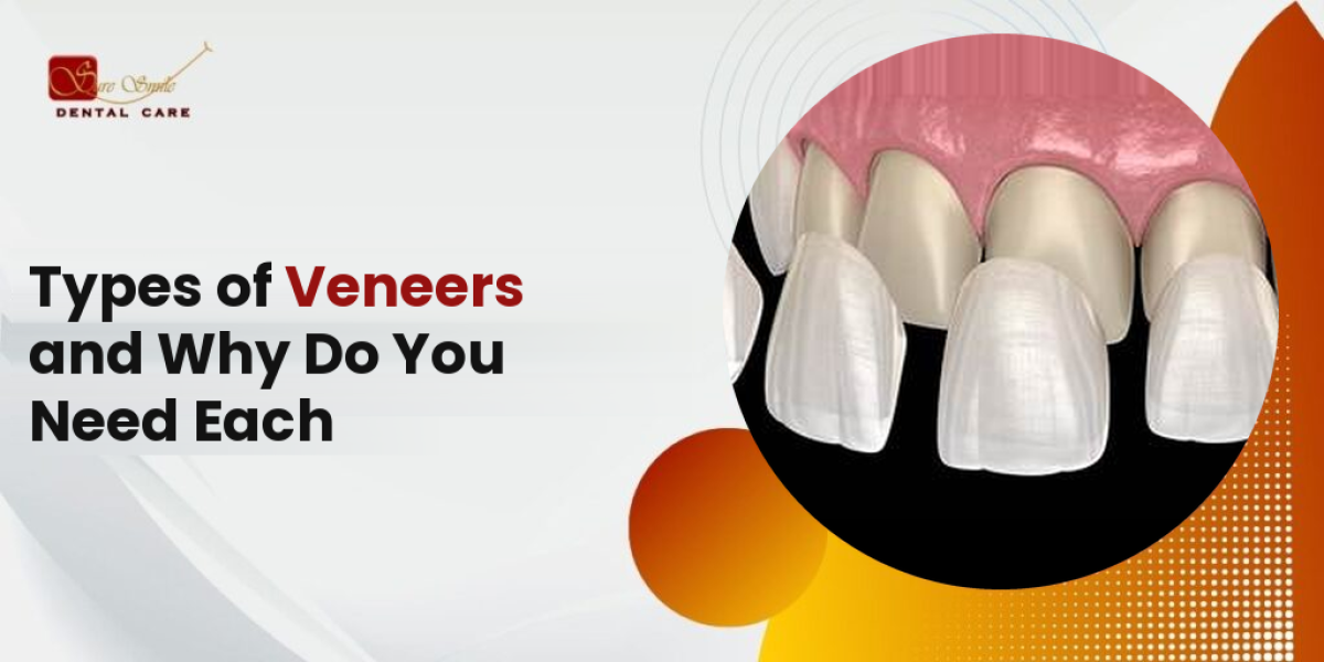 A Guide to Dental Veneers and Where to Use Each Type