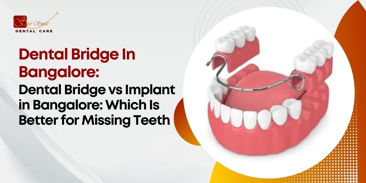Dental Bridge In Bangalore