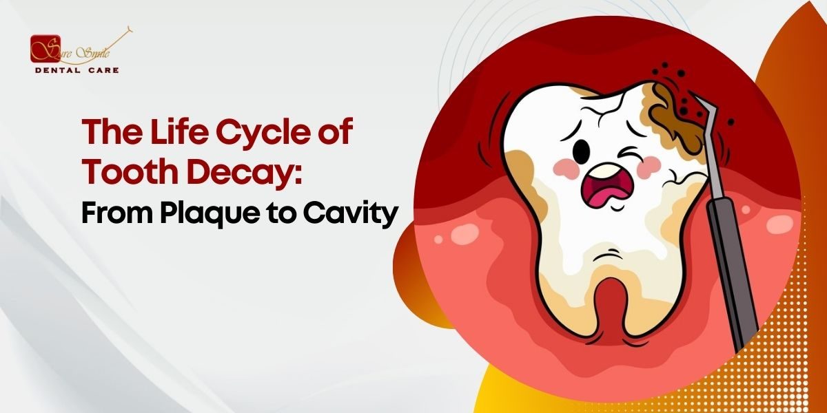 stages of tooth decay