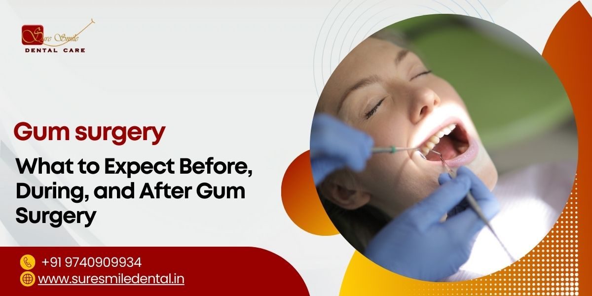 Full Mouth Dental Implants