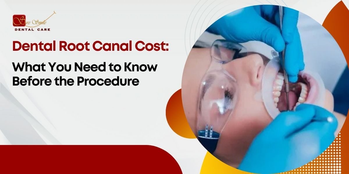 Dental Root Canal Cost
